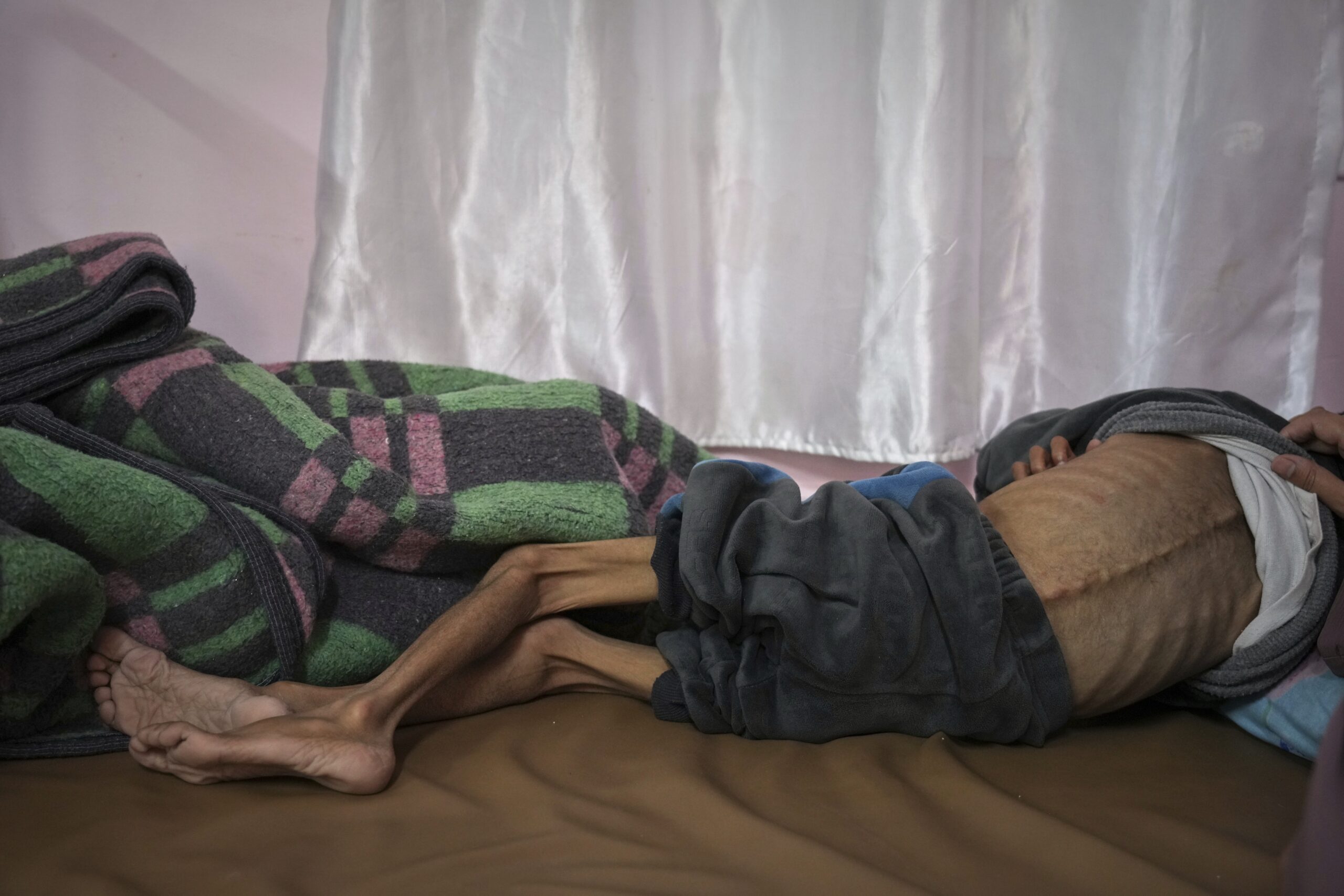 Mona al-Raqab podnosi koszulkę swojego pięcioletniego syna, Osamy al-Raqaba, odsłaniając oznaki niedożywienia oraz pogarszającego się stanu mukowiscydozy w klinice leczenia niedożywienia w szpitalu Nasser w Khan Younis. [Abdel Kareem Hana/AP Photo]
